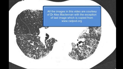 ⁣Interstitial Lung Disease Chest x-ray