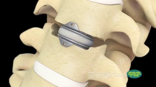 ⁣Medtronic BRYAN® Cervical Disc Surgical Technique Animation