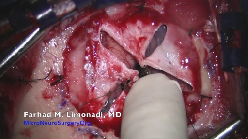 Surgical removal of glioblastoma (GBM)