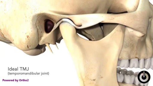 ⁣Temporomandibular joint TMJ disorder types