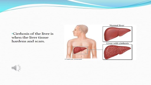 ⁣End Stage Liver Disease