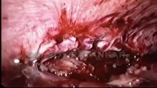 ⁣Liver Absces Drainage