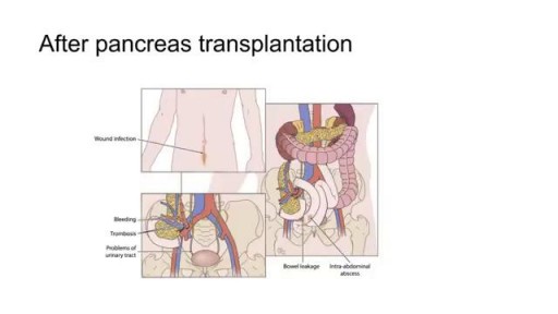 ⁣Complication of Kidney transplant