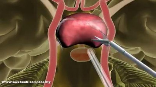 ⁣Minimally Invasive Brain Surgery To Remove Brain Tumors.