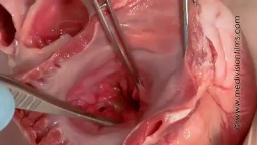 Heart Anatomy