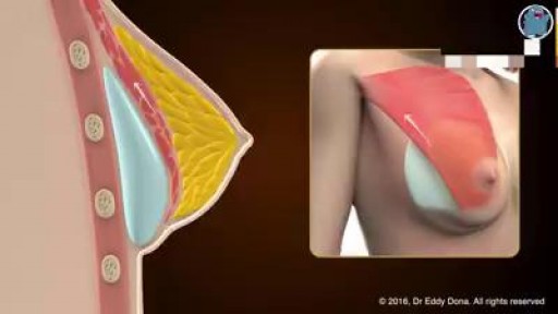 Breast different implant pockets
