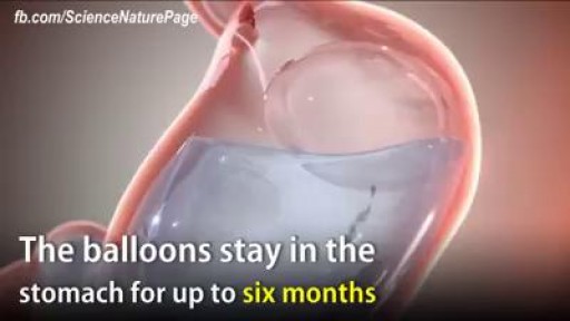 ⁣Swallowable Balloon help to loss weight