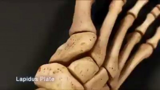 ⁣Plate and screwed fixation of Foot