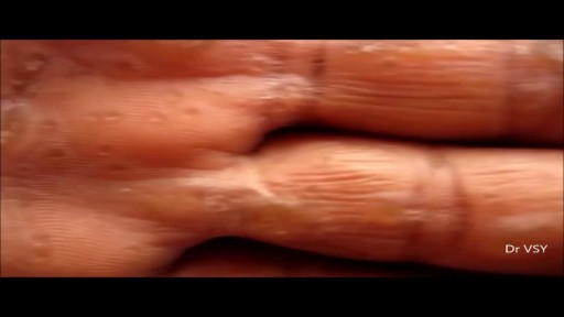 ⁣keratoderma blennorrhagicum