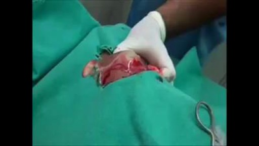 Different types of Abscess