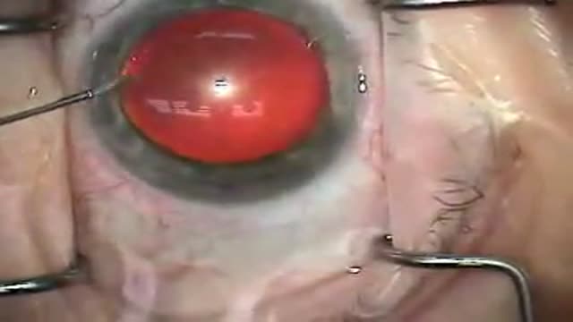 Cataract Surgery Modern Technique