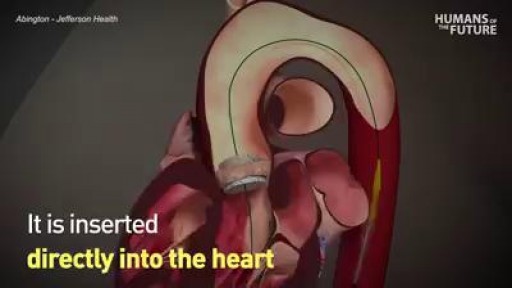 ⁣Alternative to open heart surgery
