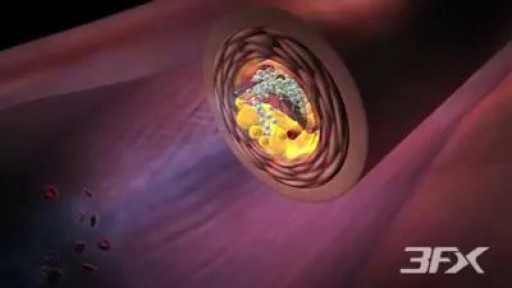⁣Diabetic Atherosclerosis.