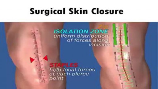 ⁣Surgical Skin Closure