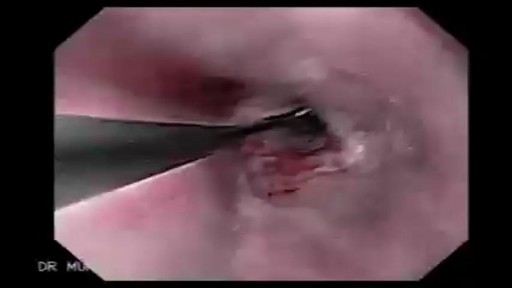⁣Esophageal Dilation Procedure
