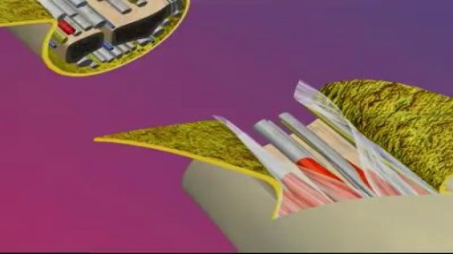 Hand Transplant Surgical procedure.
