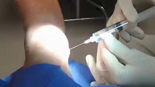⁣Ankle Screw Removal