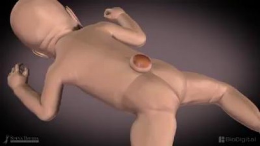 ⁣What is Spina Bifida ?