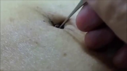 Navel stone removal from a dirty bellybutton