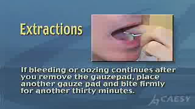 Hemostasis after Tooth Extraction
