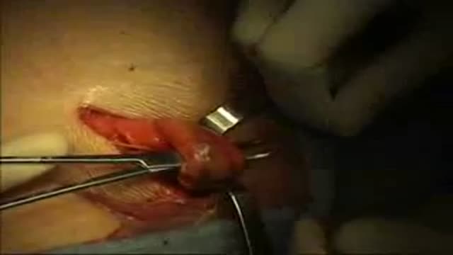 Indirect Inguinal Hernia Repair