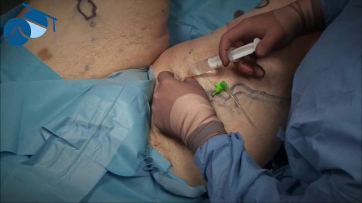 ⁣Local anaesthetic injection prior to tumescence ready for varicose vein surgery