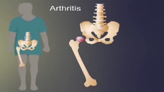 ⁣Arthritis of The Hip