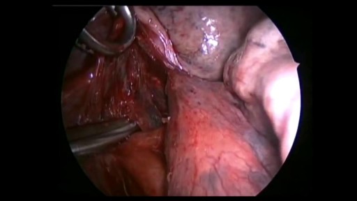 ⁣Left Lower Lung  Lobectomy