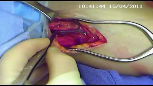 Upper arm AV  graft Surgery