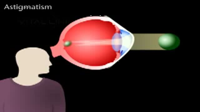 Astigmatism Animation