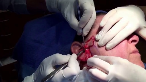 ⁣Mini Face Lift Surgery -- Short Scars -- No Anesthesia