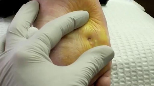 ⁣Surgical Plantar Wart Removal