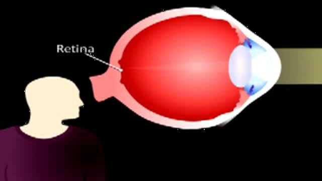 Cataract Animation