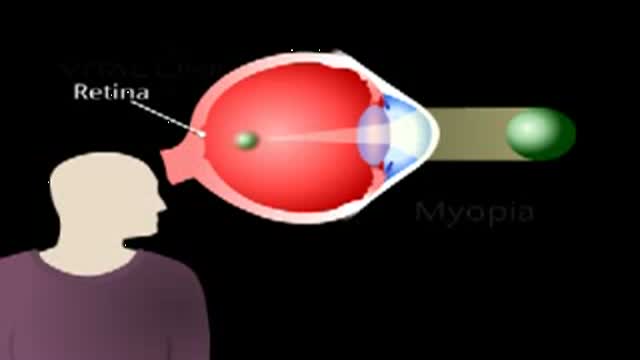 Myopia Animation