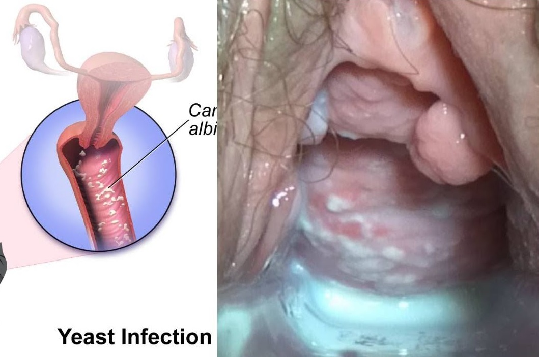 ⁣Types and Causes of Vaginal Infection Yeast or Candidiasis, Trichomoniasis or Bacterial ?