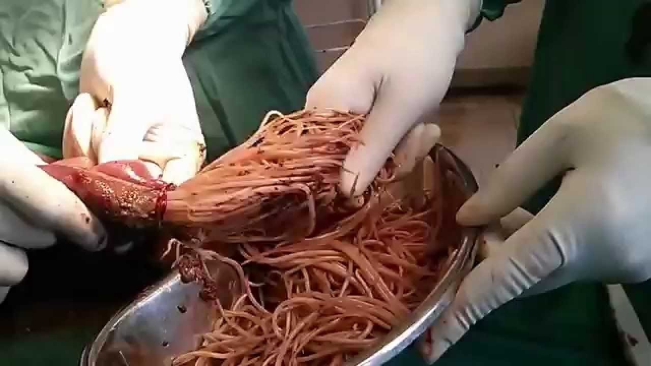 ⁣3 Years Old Intestinal Worms Removal Surgery