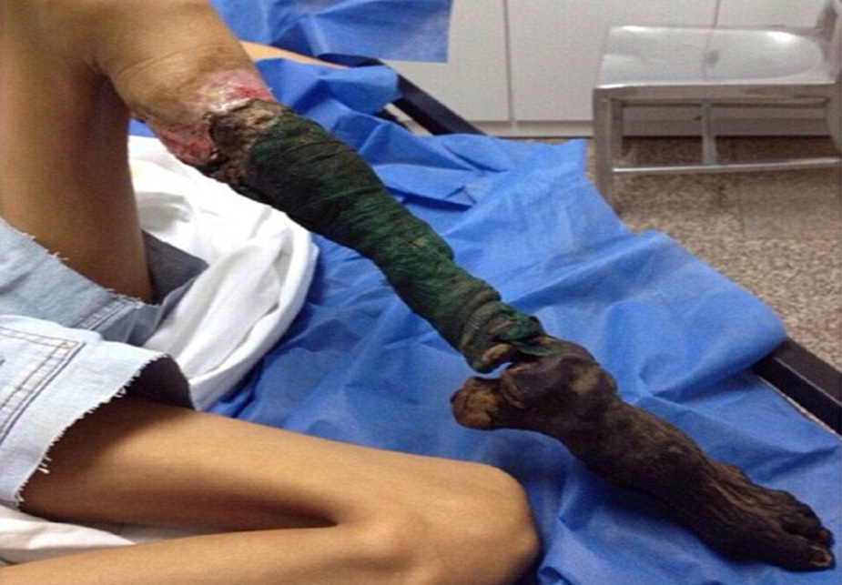 ⁣Snake bite causes girl’s leg to rot away