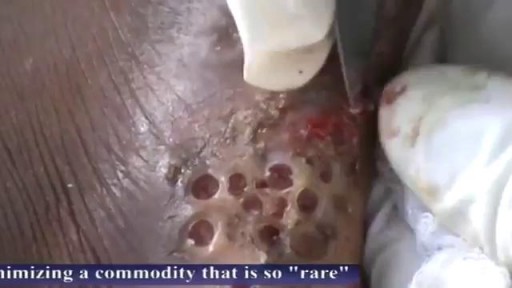 ⁣Massive Skin Jiggers Removals