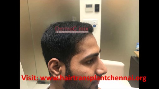 4000 Grafts, Best Hair Transplant in Chennai @DERMACLINIX | Dr Ariganesh Chandrasegaran, MD
