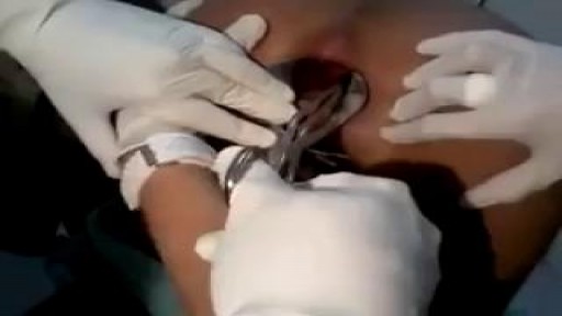 ⁣Stuck Sex Toy Medical Removal Surgery