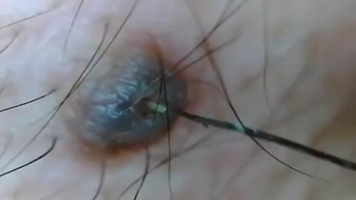 ⁣The Biggest Ingrown Hair Removed