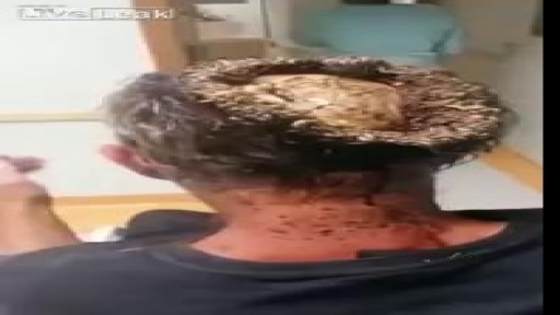 ⁣Unbelievable Head Infection Exposing a Man's Skull