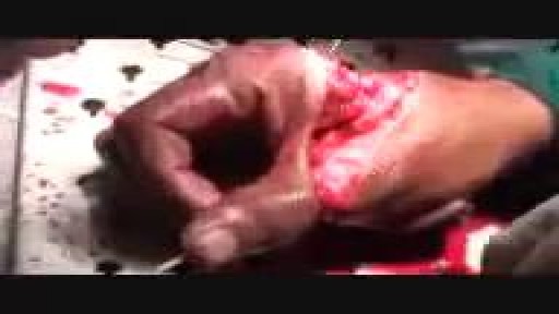 ⁣Amputated Hand Reattachment Surgery