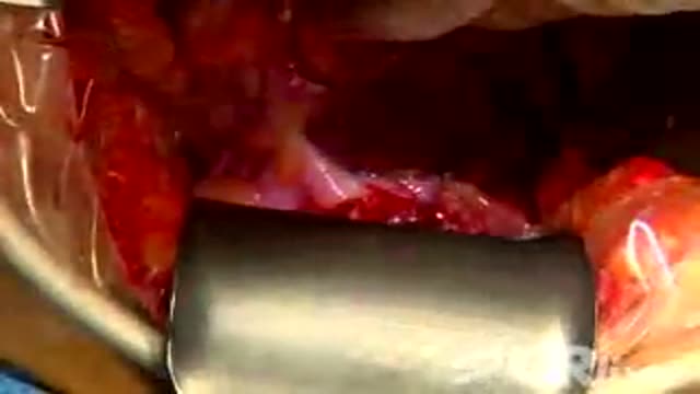 Open Colectomy without Sutures or Significant Blood Loss