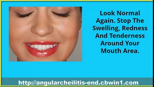 ⁣Cracked Corners Of Mouth, Cheilitis, Angular Cheilitis Remedy, Angular Cheilitis Medicine, Cheilitis