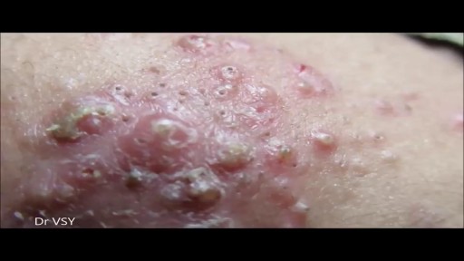 ⁣Grade III Acne Draining and Removals