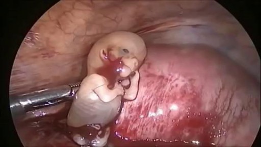 ⁣Ectopic Pregnancy Baby Abortion Surgery