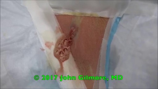 ⁣Huge Cyst Infection Popping