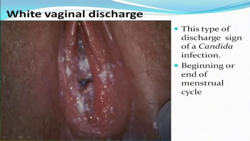 ⁣Types of Female Genital Discharge