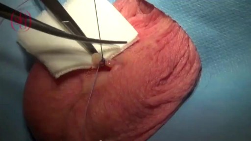 ⁣Closing Ejaculation Canal to Stop Sperm Surgery